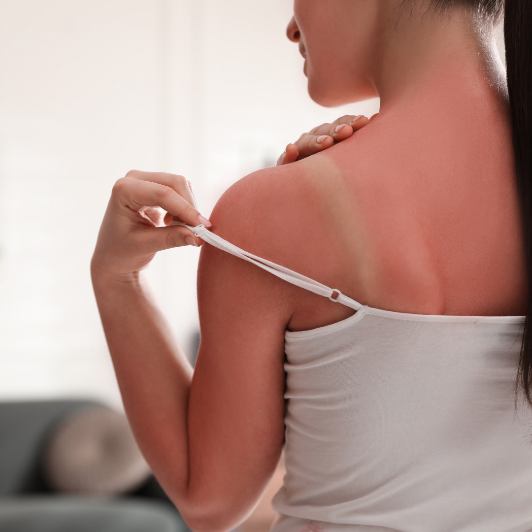 rødlysterapi solbeskyttelse, rødt lys solbrenthet, PBM SPF 15, naturlig solbeskyttelse, infrarødt lys UVB, hudreparasjon med lys